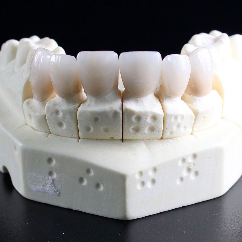 Prótesis sobre implantes