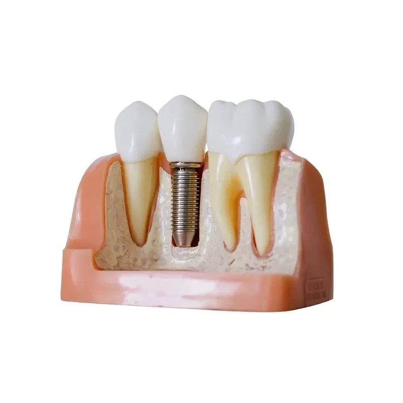 Soluciones en prótesis dentales fijas