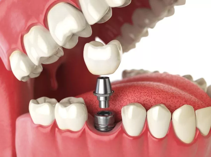 Implantes de carga inmediata para tratamientos dentales especializados