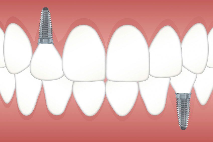 Carga inmediata de dientes