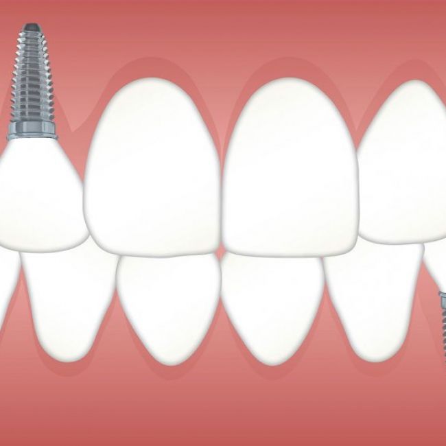 Carga inmediata de dientes